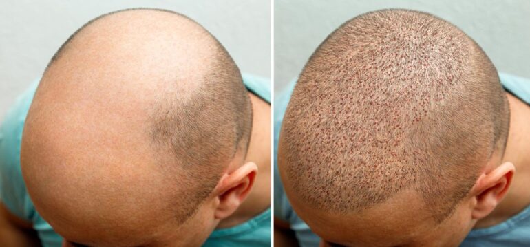 Things to Know About Before and After FUE Hair Transplant Effects