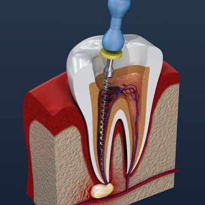 Root Canal Treatment: Understanding the Procedure and Its Benefits