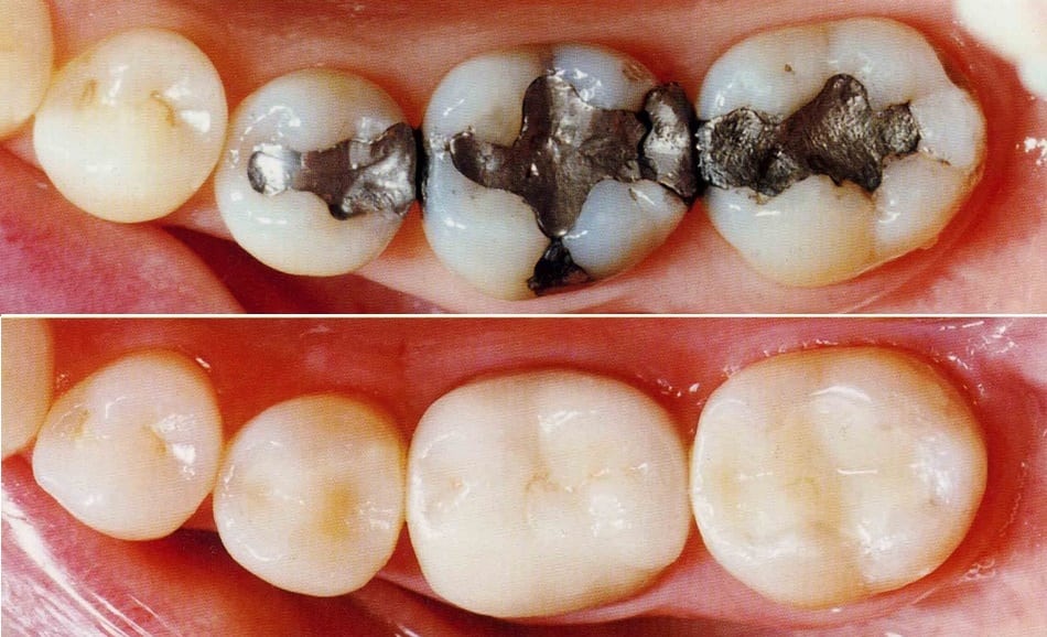 Exploring the Different Types of Tooth-Colored Dental Fillings