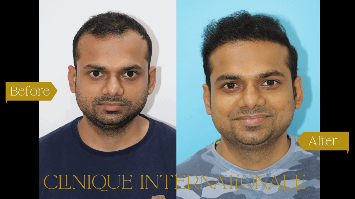 Achieving Natural Hair Restoration Excellence: The Best Hair Transplant in Pune at Clinique Internationale