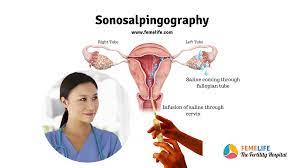 The Role of Sonosalpingography (SSG) in Diagnosing Tubal Infertility: What You Need to Know