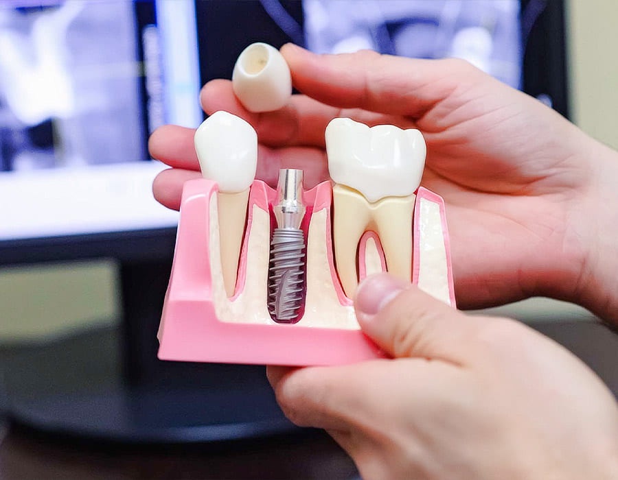 The Role of Sedation in Same Day Dental Implant Procedures: Options and Considerations
