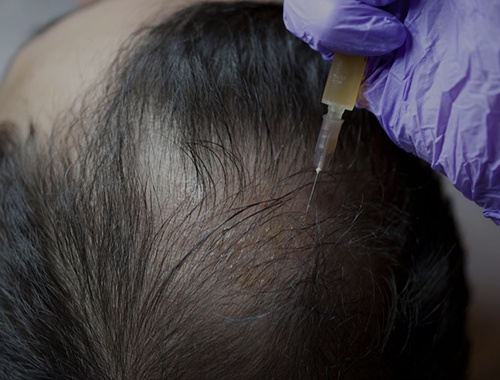 Can women also benefit from hair transplant procedures?