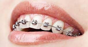 Orthodontic Excellence: Dubai's Leading Dental Braces Specialists