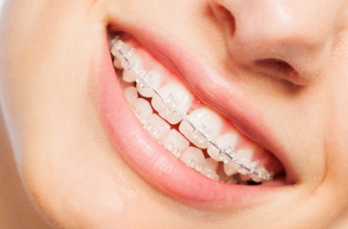 Caring for Your Ceramic Braces: Tips from Dubai Orthodontists