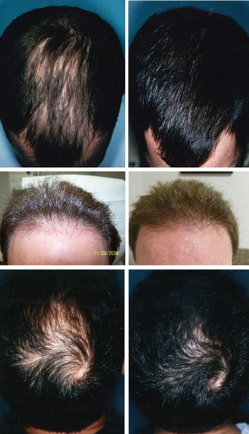 Navigating Hair Transplants While Still Experiencing Hair Loss