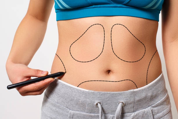 Discover the Secret to a Flawless Figure with Tummy Tuck in Dubai