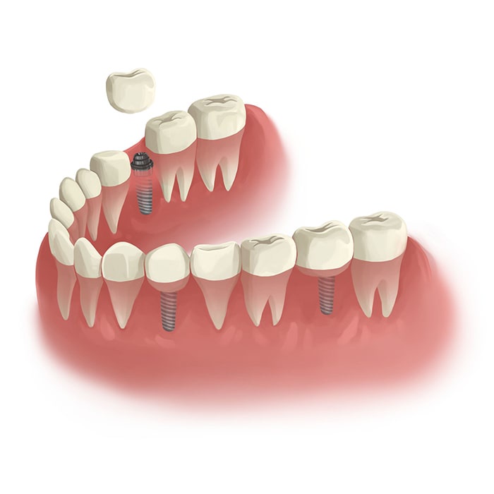 Factors Influencing Tooth Extraction: Navigating the Challenges