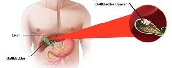 Laparoscopic Cancer Surgery for Effective Treatment