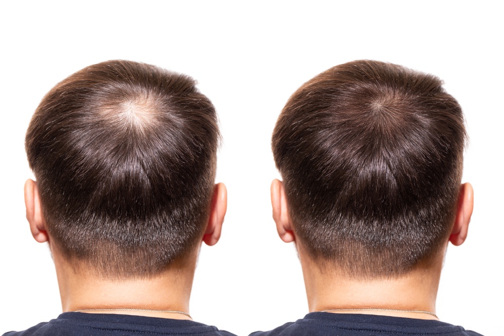 Hair Transplants for African American Hair: Special Considerations