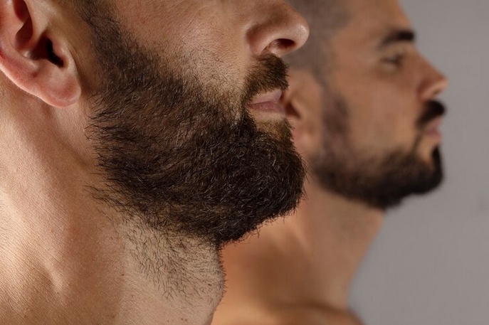 From Patchy to Perfect: The Turkey Beard Transplant Phenomenon
