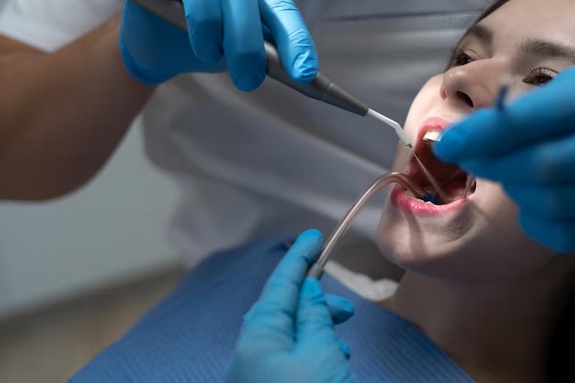 Filling the Gaps: Understanding the Basics of Teeth Fillings