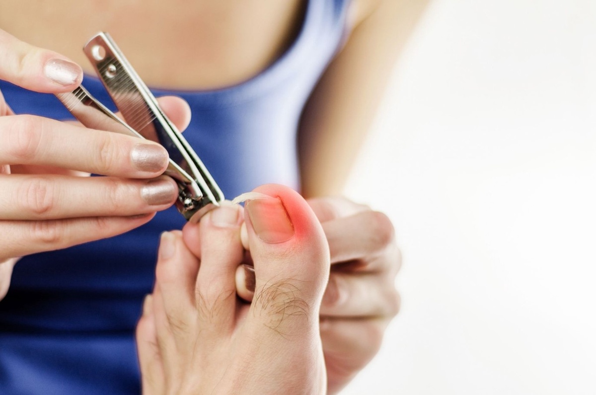 Infection Prevention: Tips for Managing Ingrown Toenails Safely