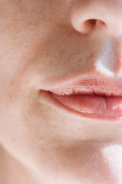 Perfecting Your Pout: Lip Filler Correction Explained