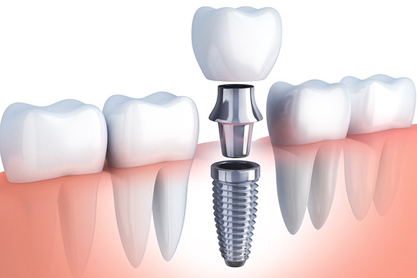 How Does Age Affect the Success of All-on-4 Dental Implants?