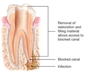 Breaking Down The Cost Factors Associated With Endodontic Treatments