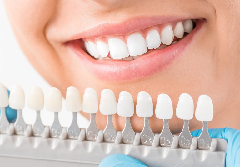 Discovering the Benefits of Dental Implants in Mount Pleasant