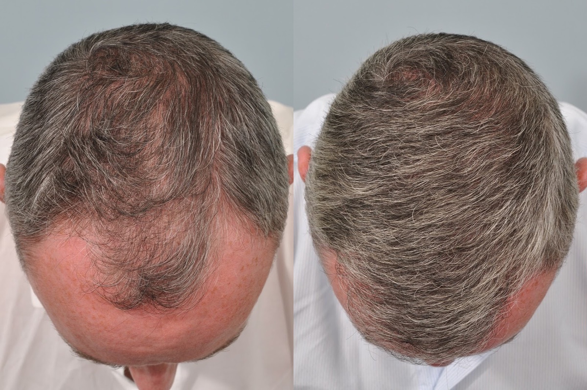Hair Transplant at the Age of 40