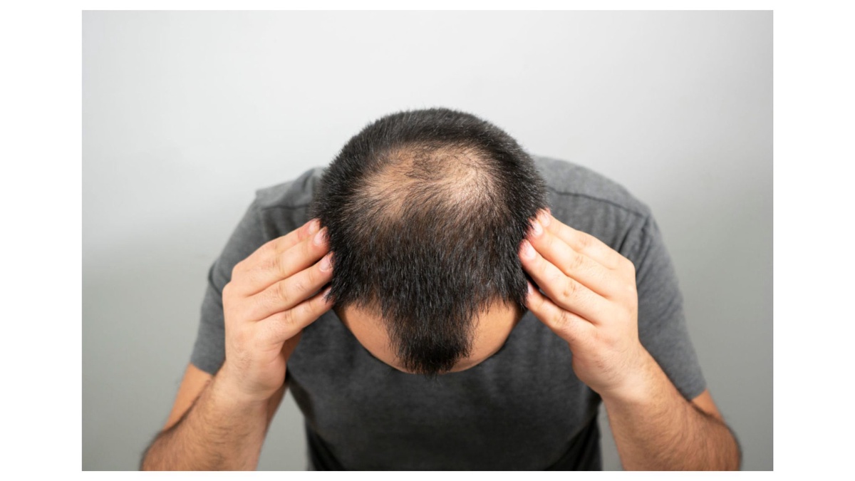 Understanding the Causes of Men's Hair Loss and Effective Solutions in Yorba Linda