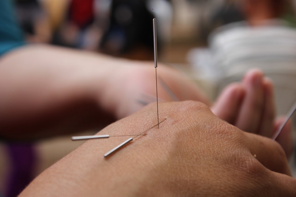 Top 7 Acupuncture Spots in Winnipeg for Instant Relief