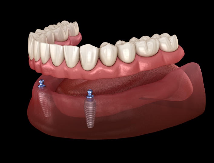 Dubai's Finest Dental Implant Solutions Unveiled