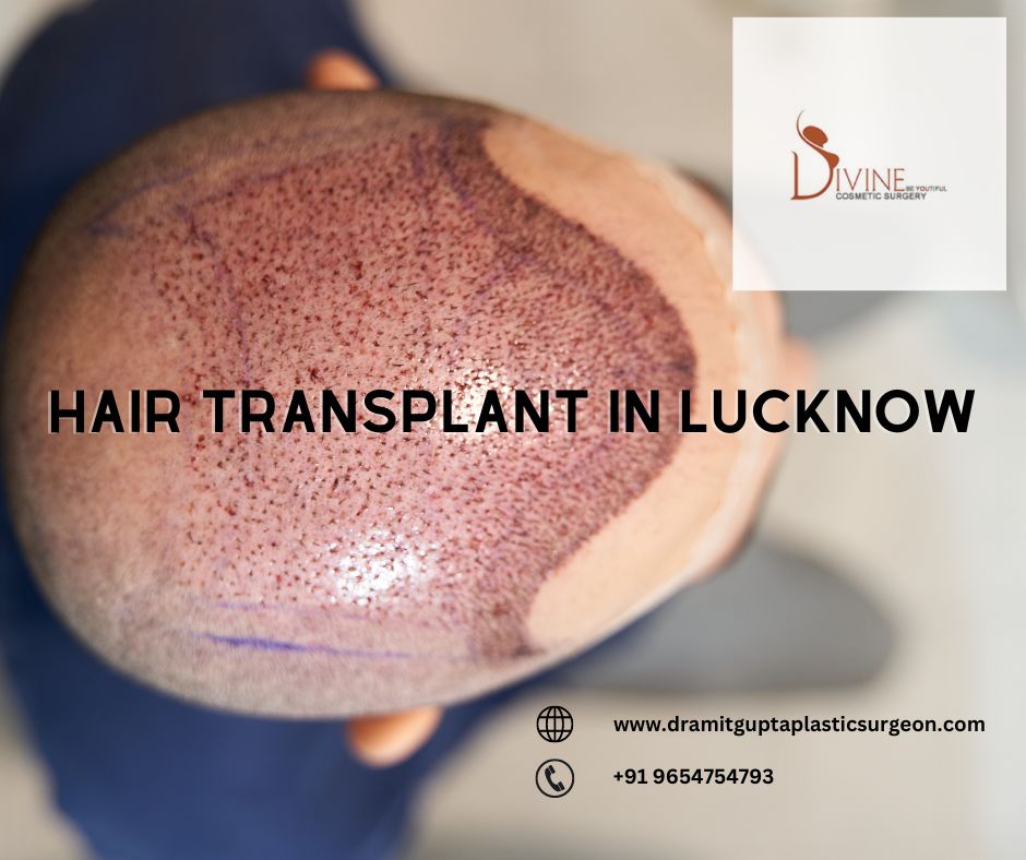 Best Results & Cost of Hair Transplant in Lucknow