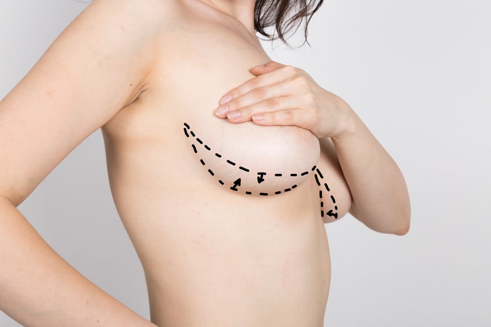 Differences Between Breast Lift and Breast Augmentation
