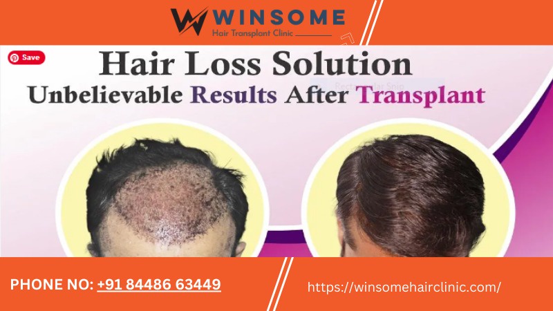 The Hair Transplant For High Grade Baldness Can Help You Regain Your Personality