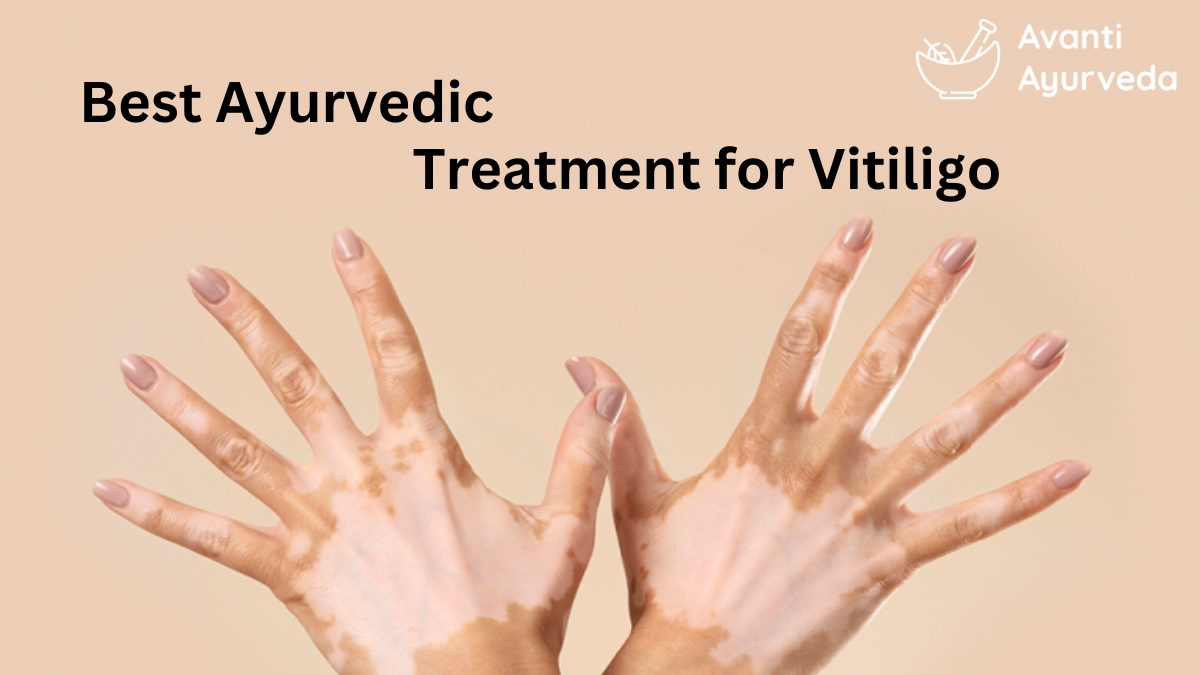 What are the best Ayurvedic medicines for vitiligo?