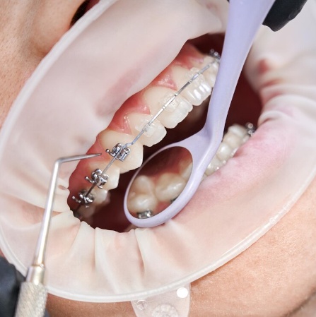 Recognizing the Elements That Impact the Cost of Dental Braces