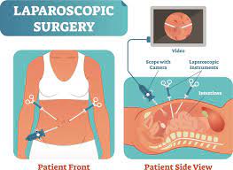 "Empowering Health: Laparoscopy Surgeon in Mumbai Transforming Lives, One Procedure at a Time"
