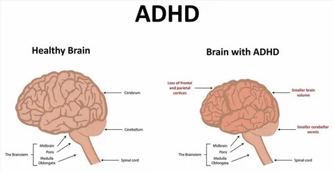 Handling Impulsivity and Hyperactivity in the Treatment of ADHD