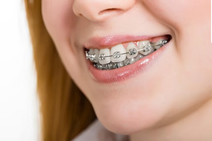 Instant Gratification: The Rise of Same Day Dental Implants