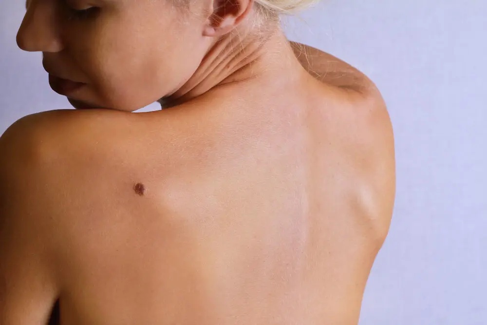 "Embracing Change: The Decision to Pursue Birthmark Removal"