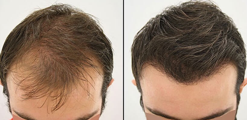 Discovering the Science Behind Effective Hair Transplant Surgery