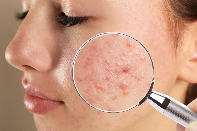 Dubai's Skincare Revolution: Unveiling the Best Acne Treatment Yet!