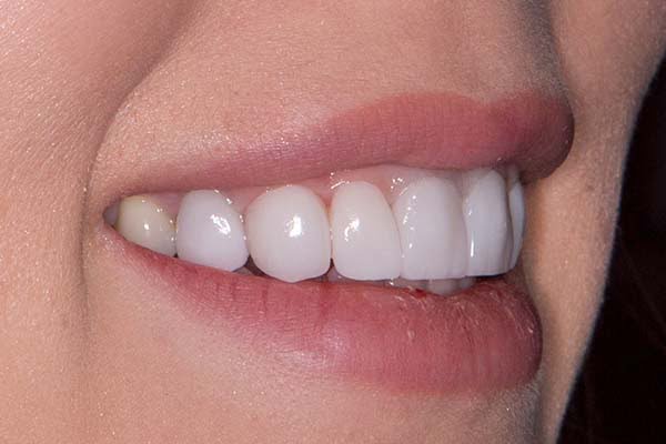 Why Dental Veneers Are the Best Solution for Crooked Teeth