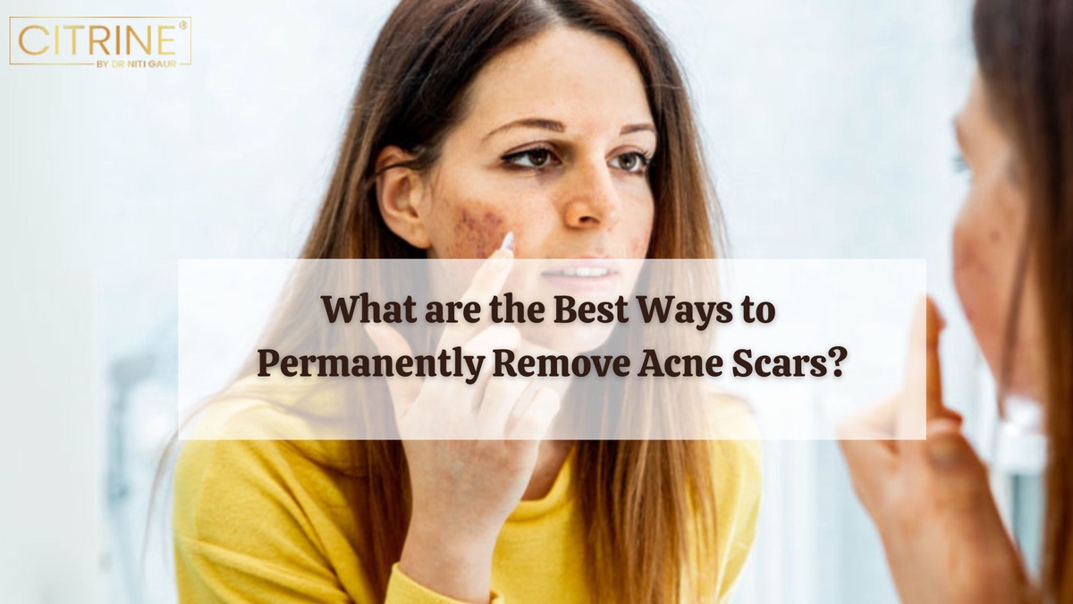 What are the Best Ways to Permanently Remove Acne Scars?