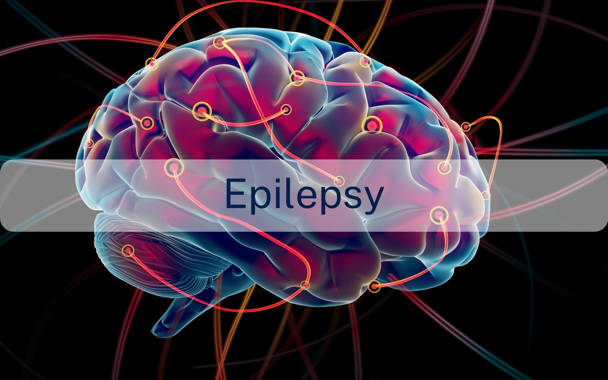 Epilepsy Revealed: Dispelling Myths and Telling Tales