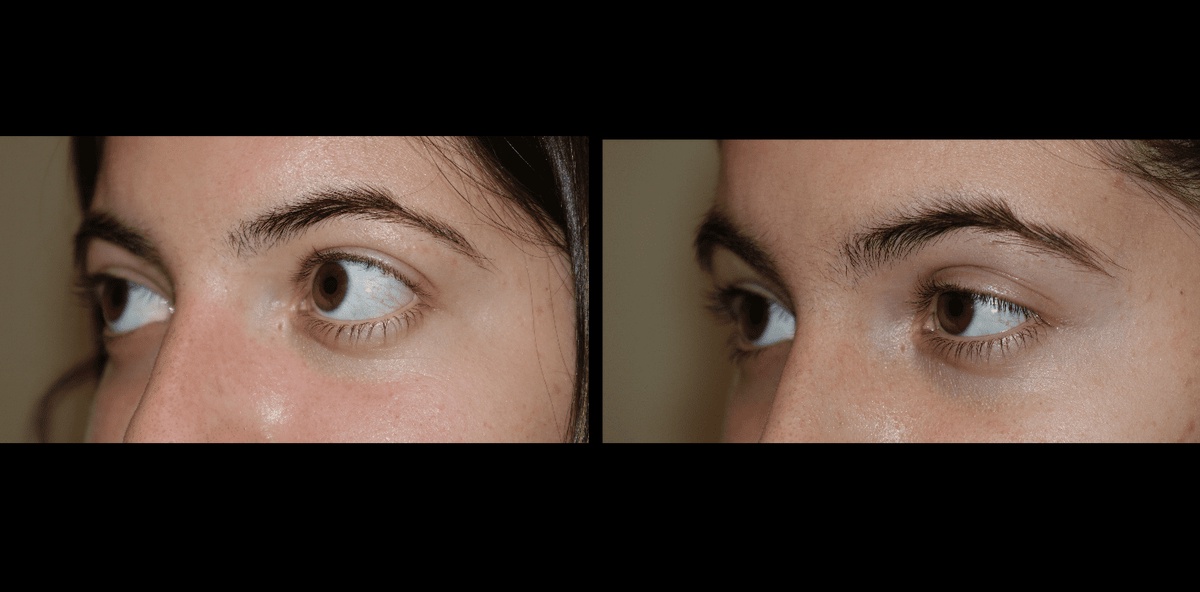 The Evolution of Techniques: Innovations in Double Eyelid Surgery Practices in California
