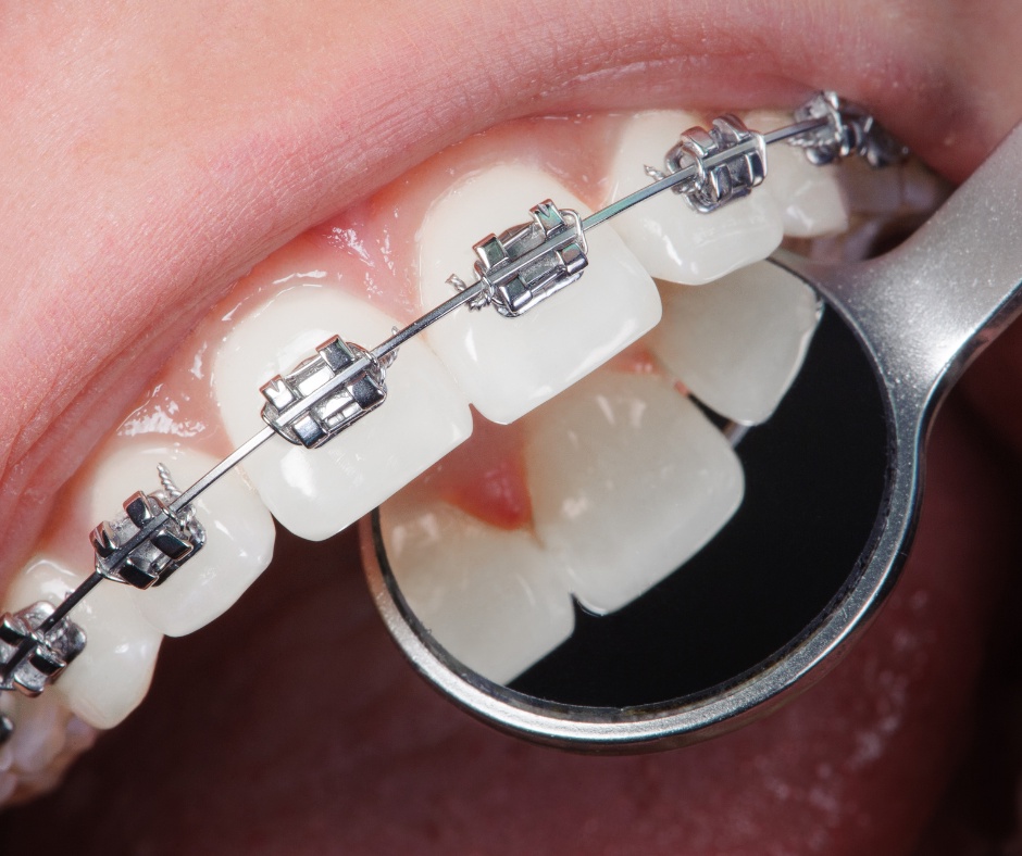 A Confident Smile Starts Here: The Transformative Benefits of Dental Braces