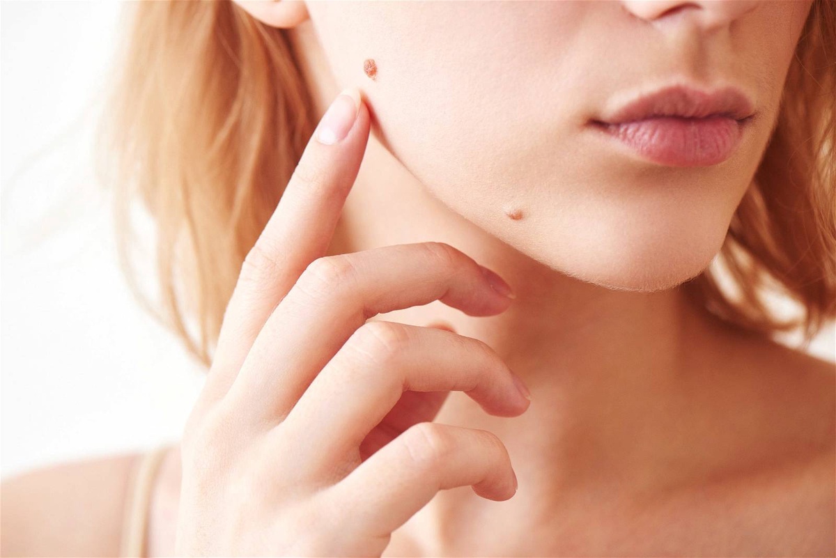 Expert Mole Removal in Dubai: Your Solution