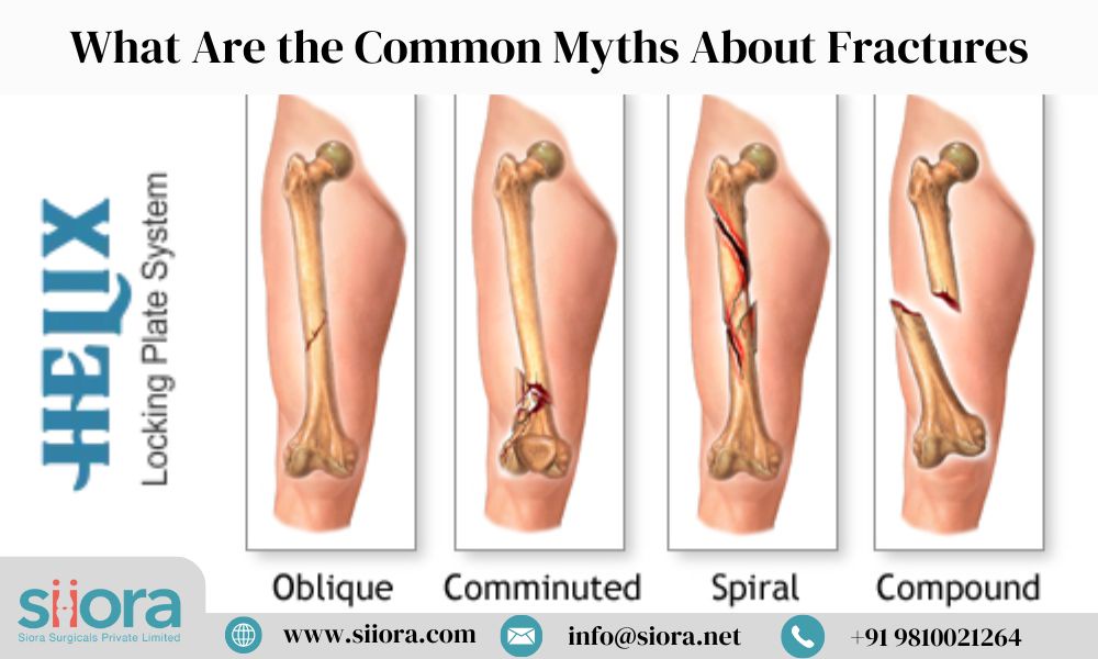 What Are the Common Myths About Fractures?