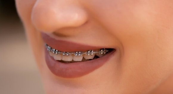 A Comprehensive Guide to Dallas Braces: Everything You Need to Know