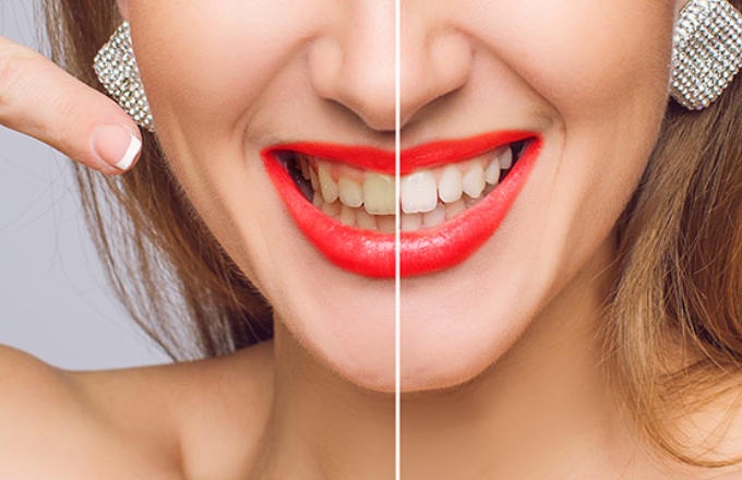 How Teeth Whitening Services Have Evolved in 2024