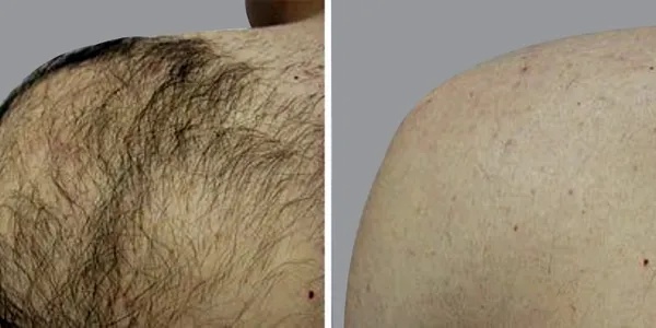 How Safe Is Laser Hair Removal?