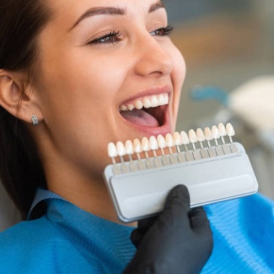 Everything You Need to Know About Dental Veneers