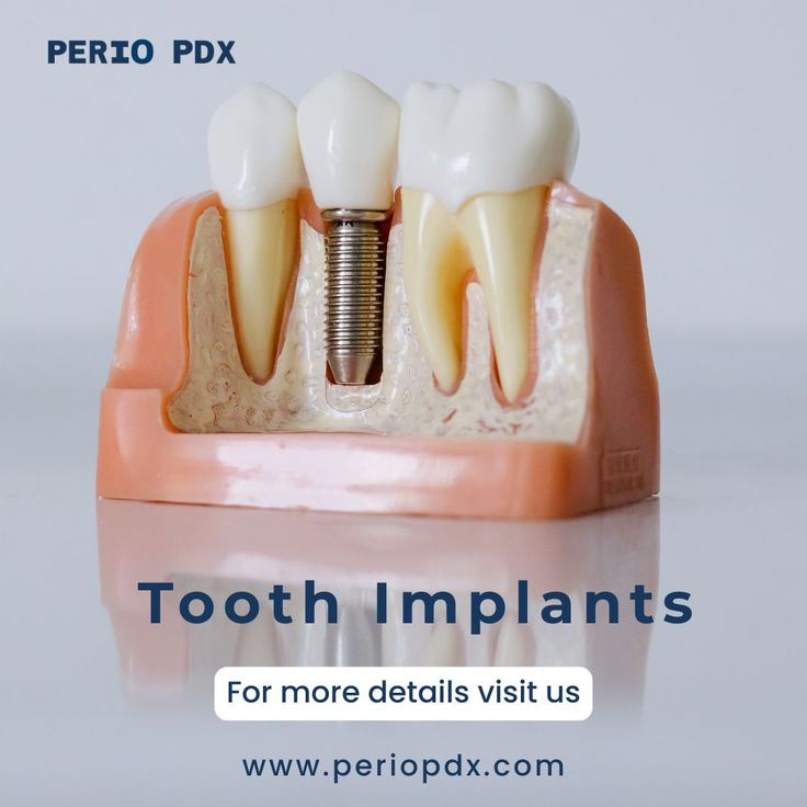 What are the side effects of Tooth implants?