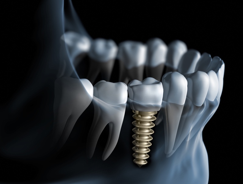Advanced dental implants to restore your smile