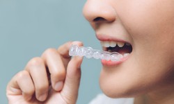 5 Unique Reasons To Opt For Clear Braces